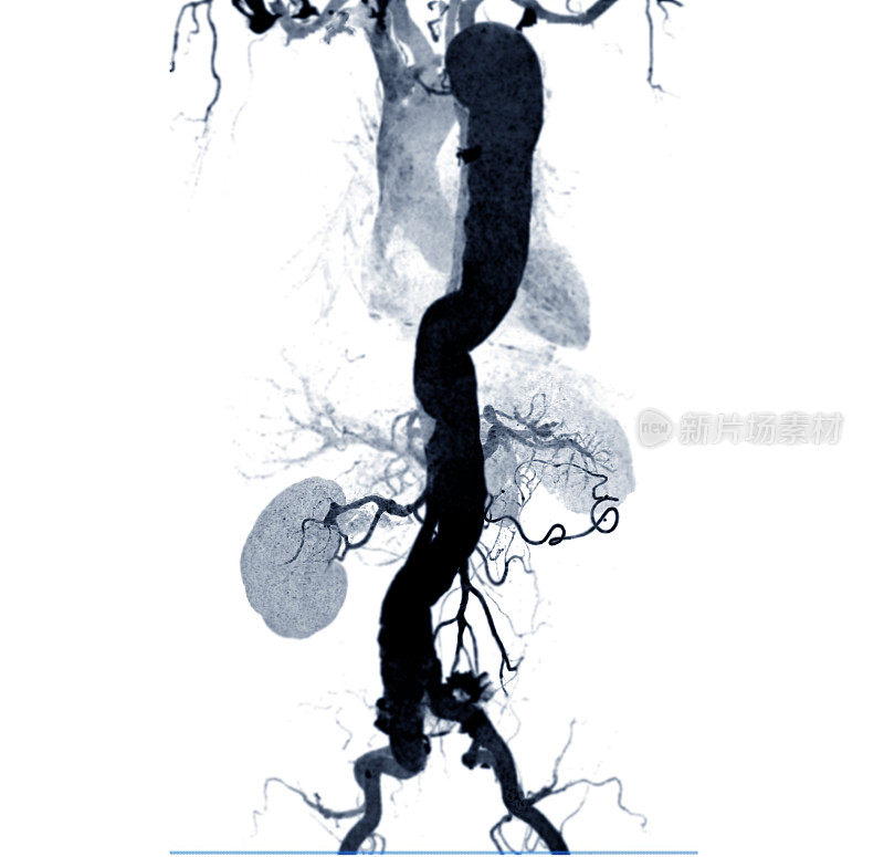 CTA腹主动脉3D MIP图像，白色背景。